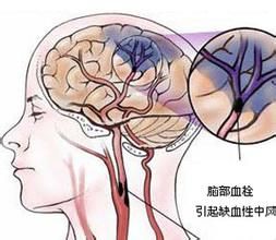 腦梗塞