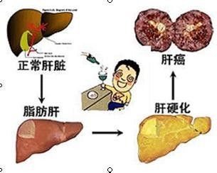 脂肪肝