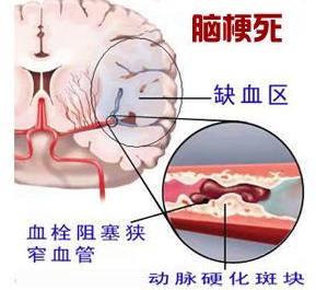 腦梗死