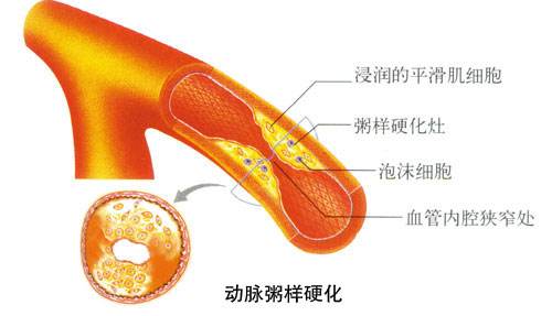 動(dòng)脈粥樣硬化