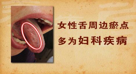 三七對(duì)血瘀有改善作用