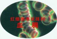 北京戴先生患有血稠的癥狀